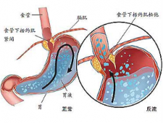 食管运动失调有哪些临床症状？